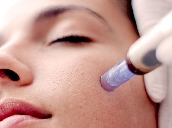 Close Up Of Microneedling Treatment